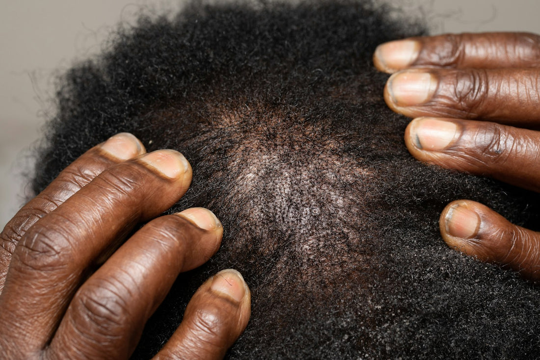 Mains écartant les cheveux pour examiner le cuir chevelu